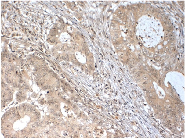 Immunohistochemical staining of FFPE human colon carcinoma tissue using DICER1 antibody (Cat. No. X2756P).  Antibody used at 1 µg/ml and visualized using DAB.  Pathologists Comments: Cytoplasmic staining on mucous cells.